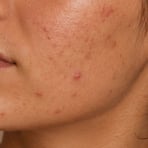 Close-up of acne on the skin