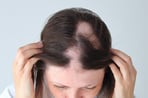 Example of alopecia areata hair loss