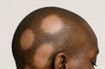 Example of alopecia areata hair loss