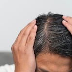 Close-up of thinning hair on the scalp