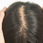 Widening part line on the top of the scalp