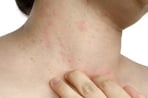 Example of atopic dermatitis (eczema) on the skin