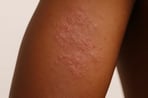 Example of atopic dermatitis (eczema) on the skin