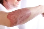 Example of plaque psoriasis on the skin