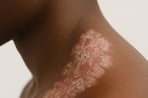 Example of plaque psoriasis on the skin
