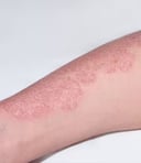 Example of plaque psoriasis on the skin