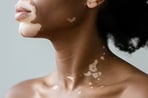 Example of vitiligo on the skin