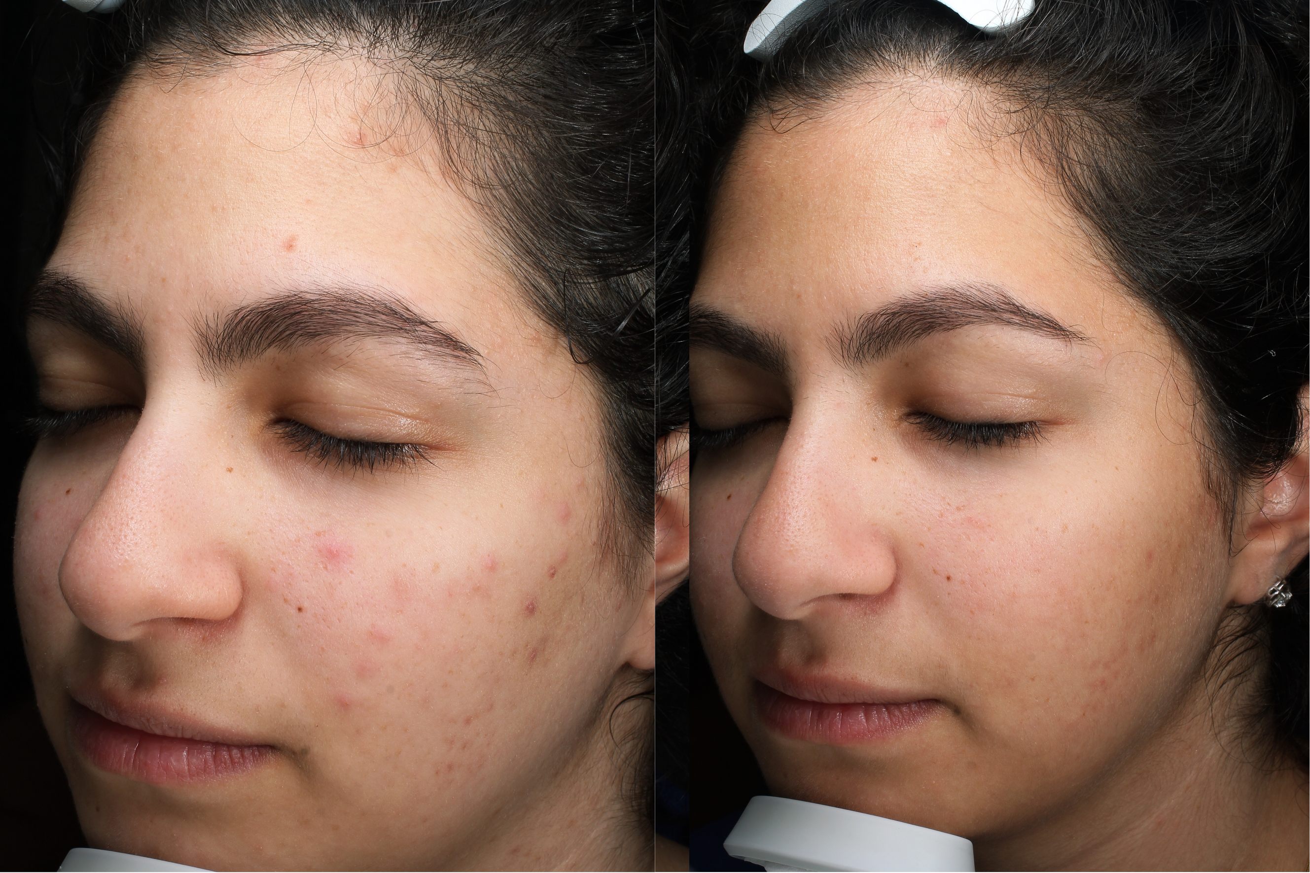 Before and After Result